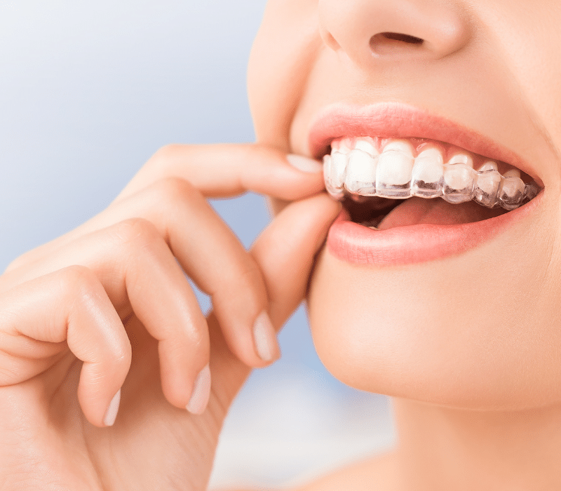 What are Invisalign Aligners, and How Does Invisalign Treatment Work?