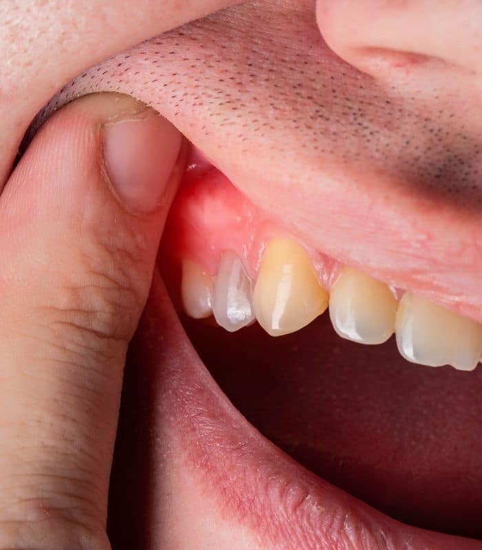 Best Home Remedies for Swollen Gums