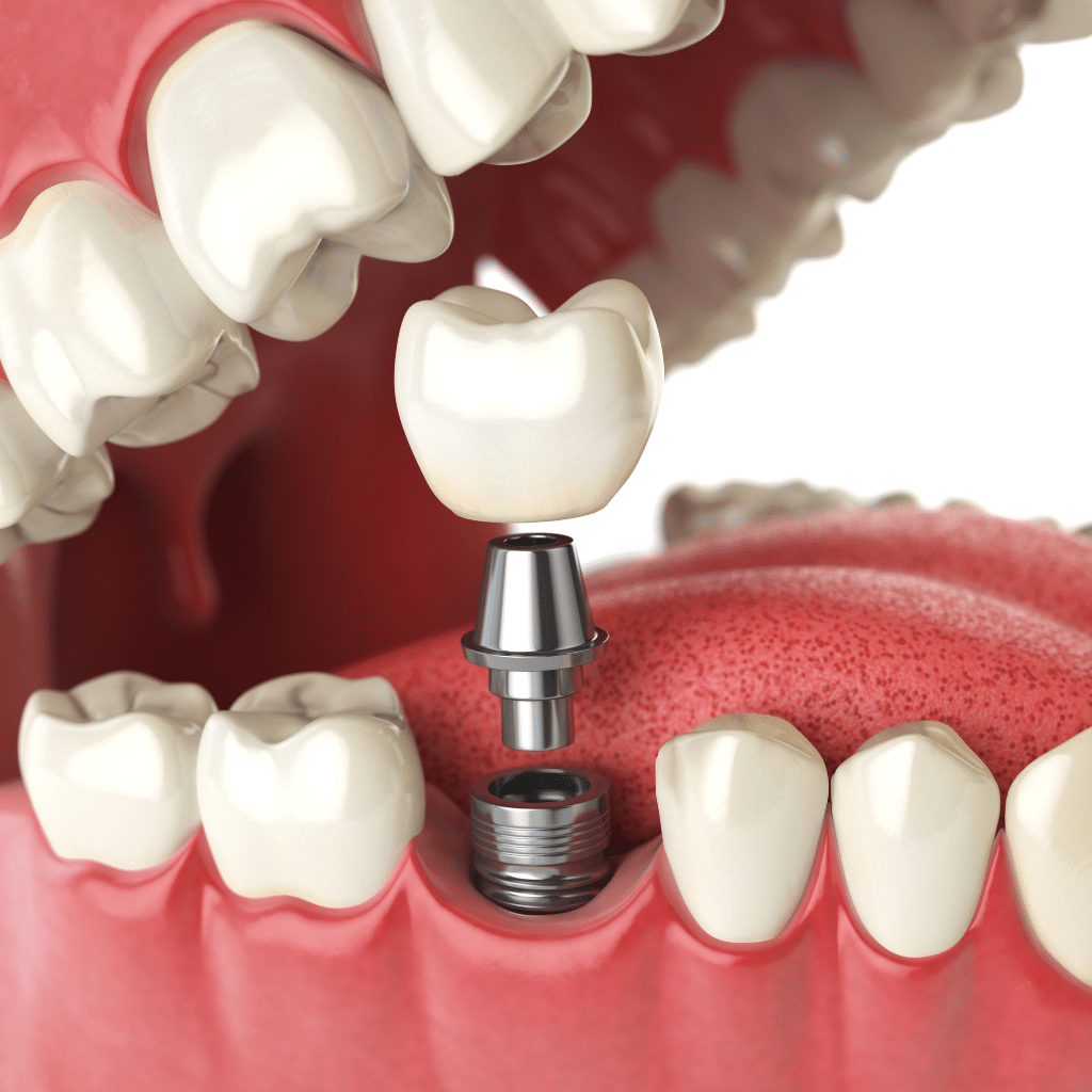 What Are Screwless Dental Implants and How Do Screwless Implant Systems Work?