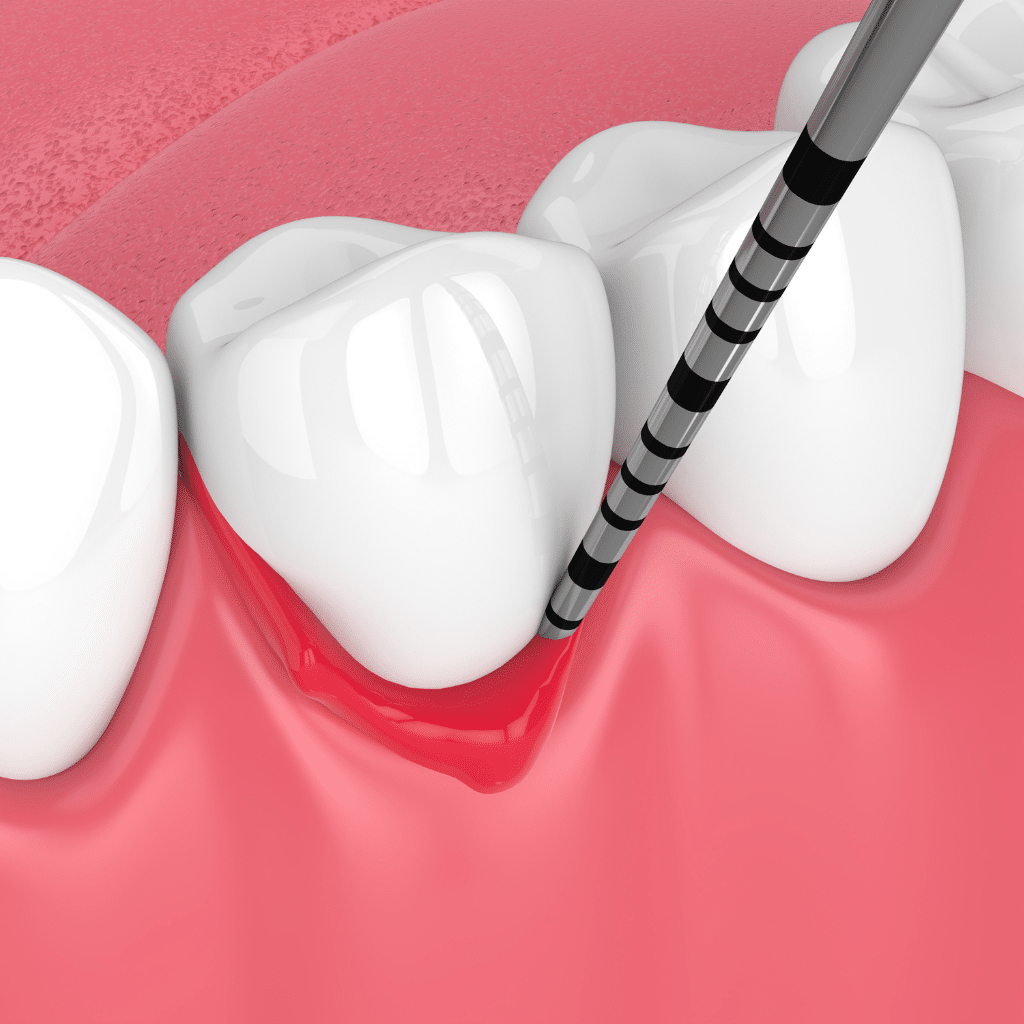 What Is Gum Treatment: Tackling Periodontal Disease and Care