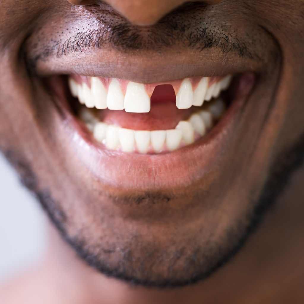Types of Tooth Replacement Options for a Perfect Smile