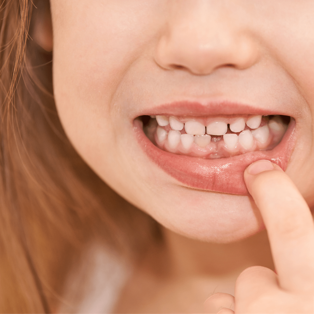 filling gap tooth