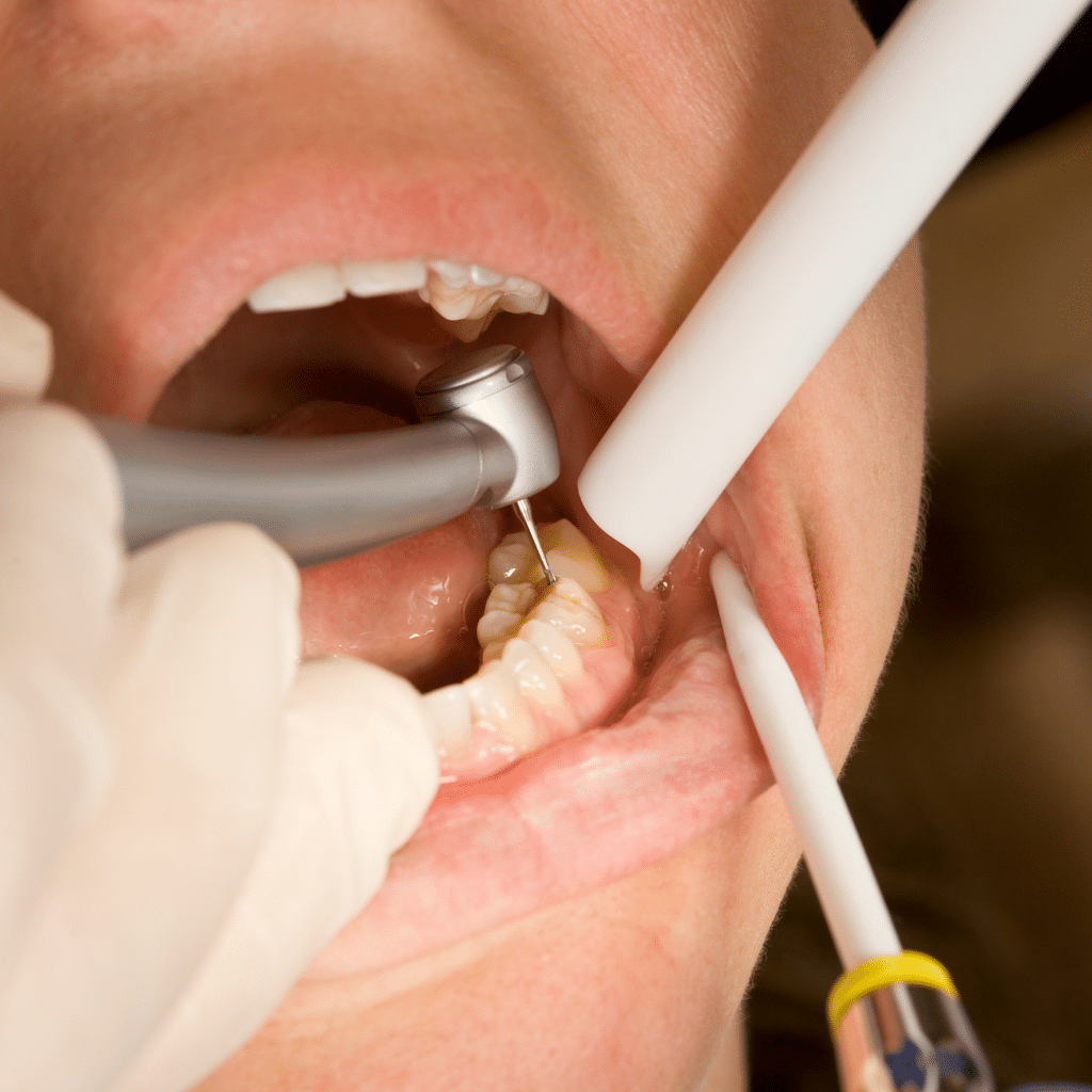 how to get a tooth gap