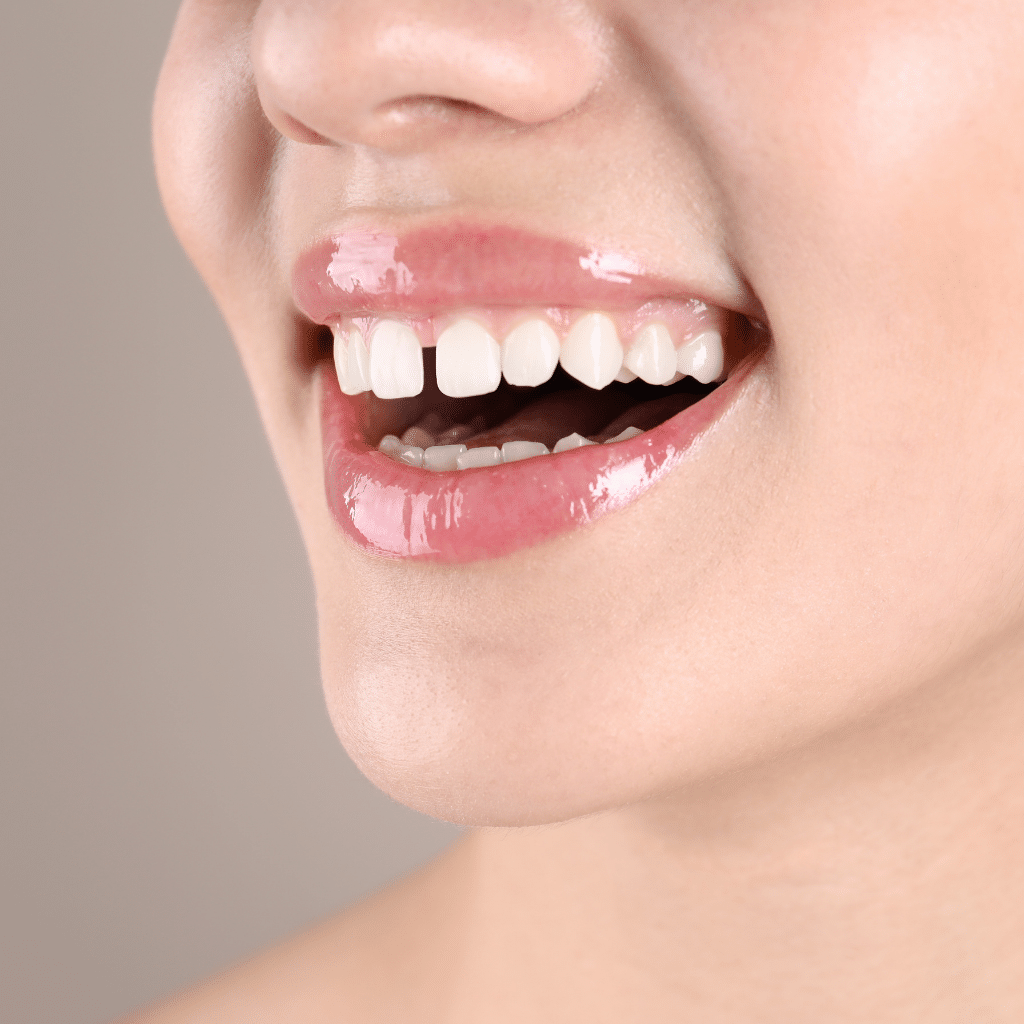 can gap tooth be fixed