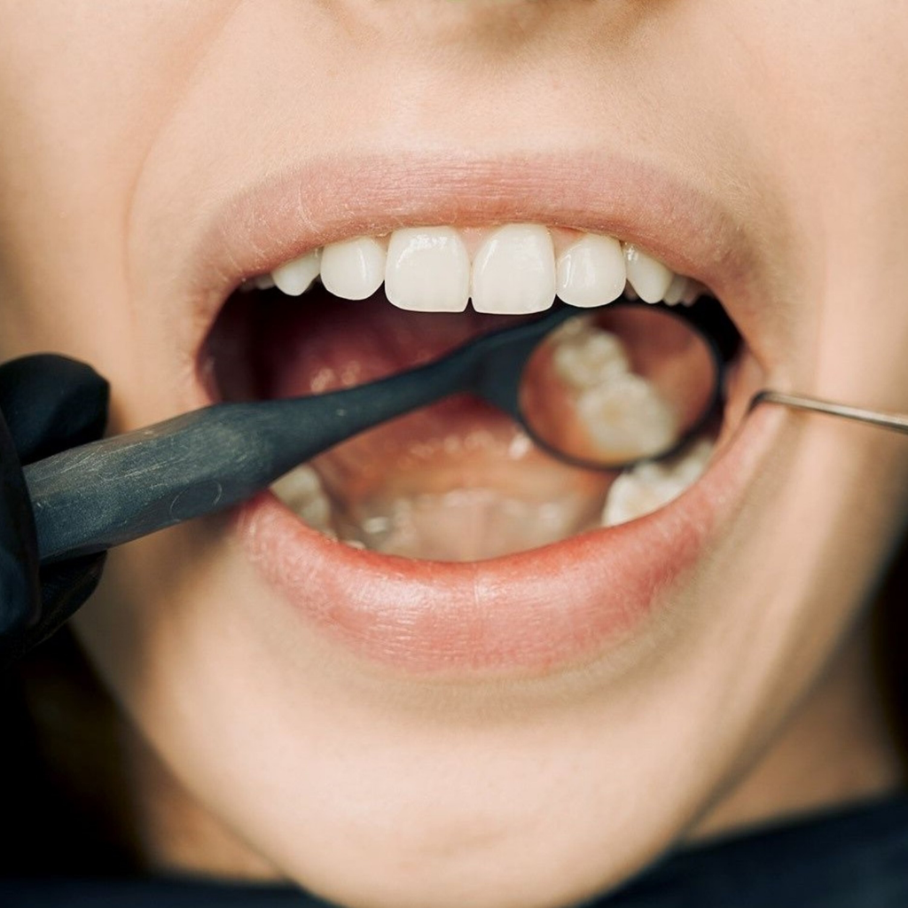 how to straighten overlapping teeth