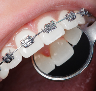 braces and clips