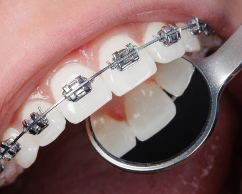 braces and clips